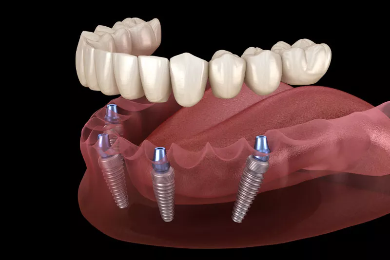 Healing Time After Dental Implants: What You Should Know